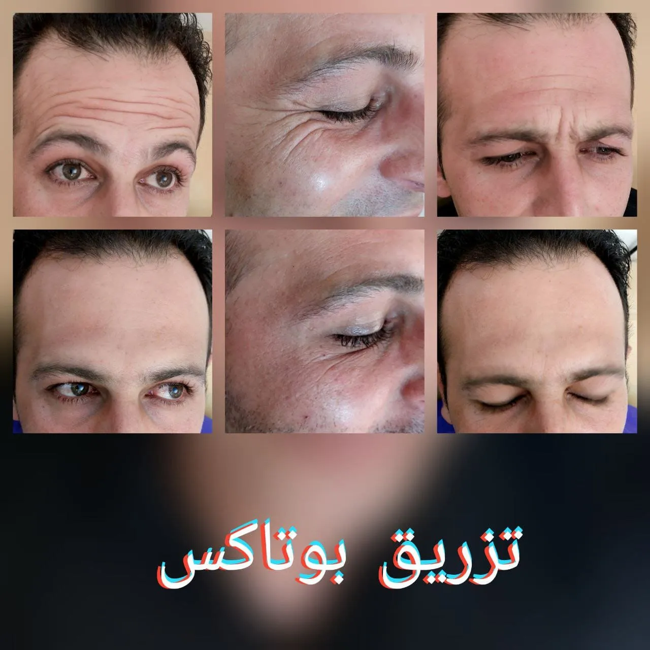 بوتاکس پیشانی