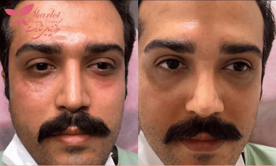 تزریق بوتاکس
