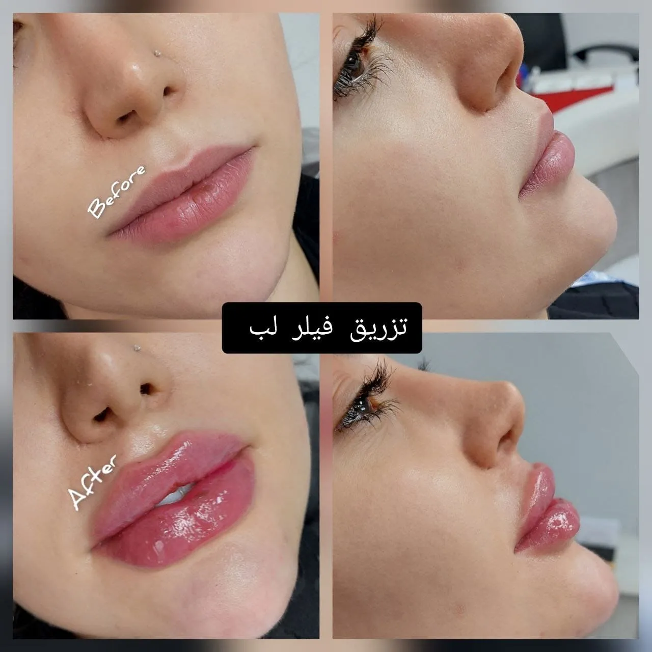 فیلر لب
