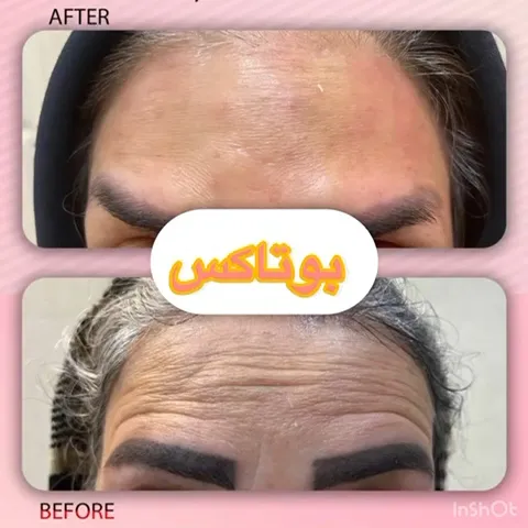 تزریق بوتاکس برای زیباجوی عزیز در ناحیه پیشانی