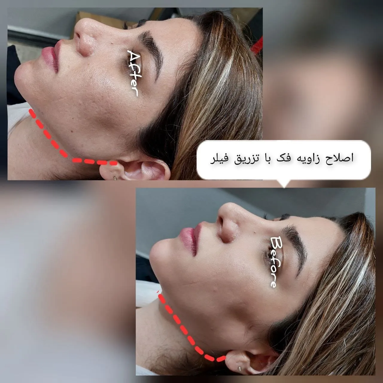 تزریق فیلر