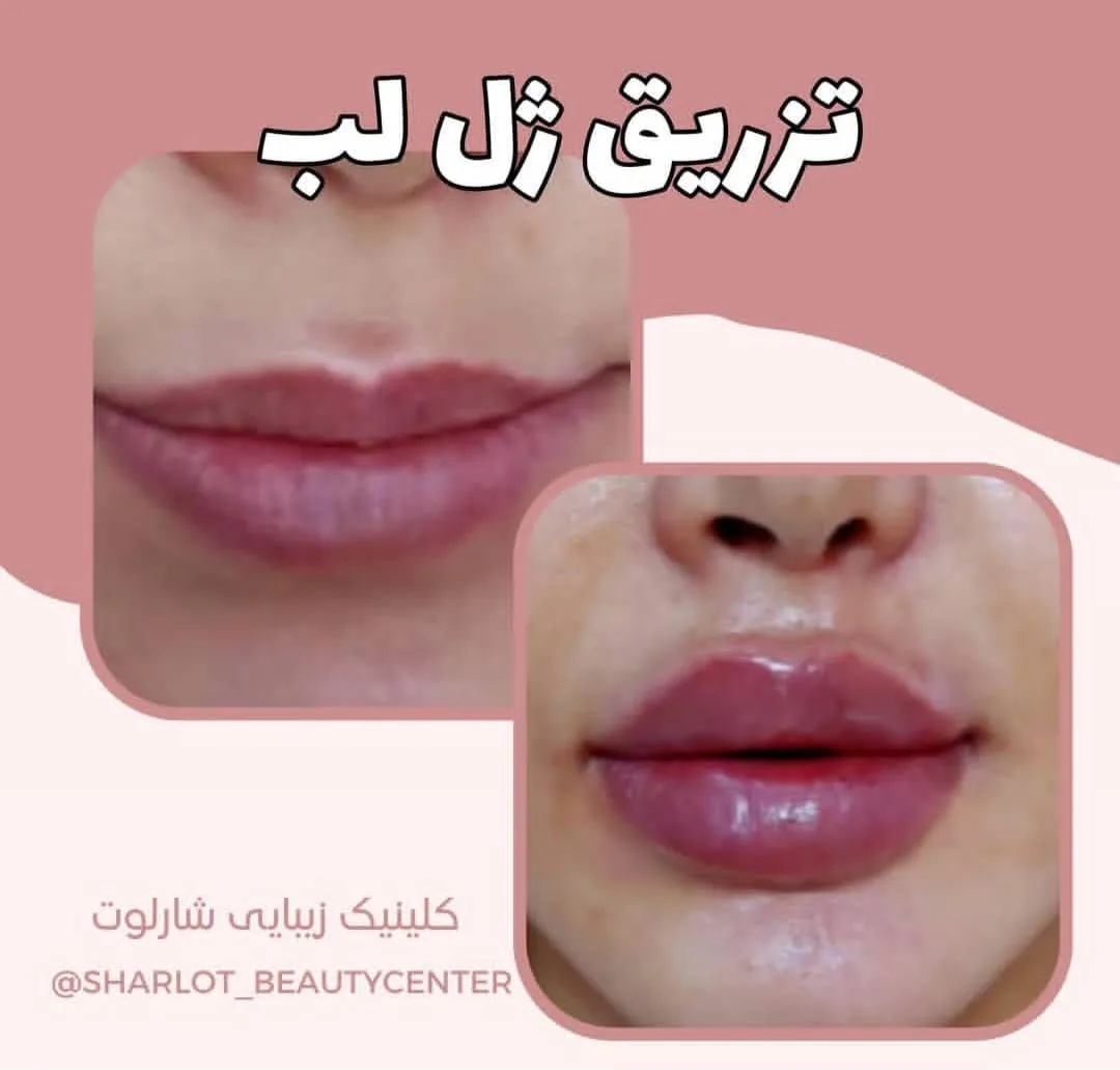 ژل لب